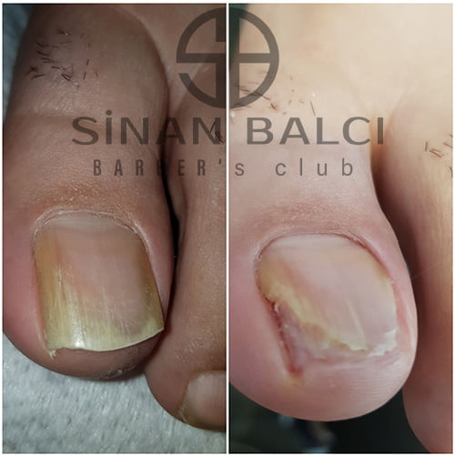 Erkek Batık Tırnak 6 svg%3E