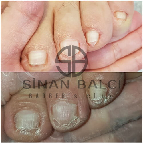 Erkek Ayak Nasır 1 beytepe ayak nasir tedavisi